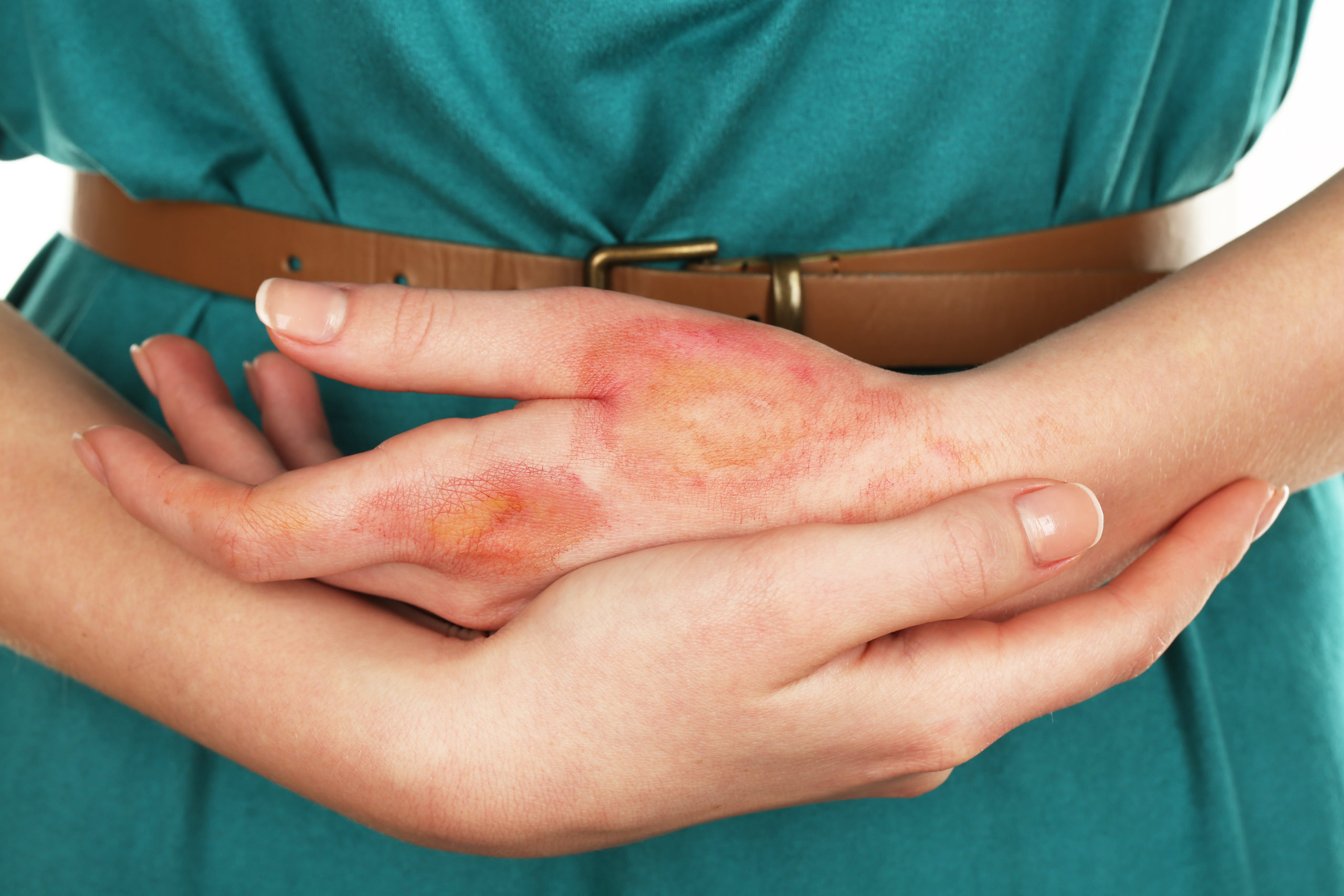 What To Do If You Get Burned WellCare